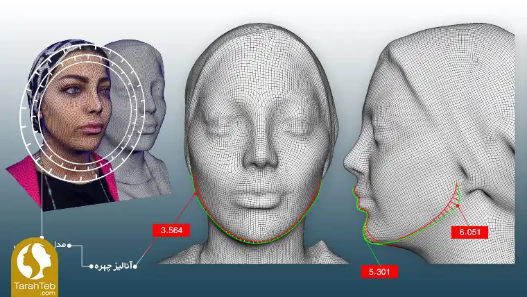 مرحله سوم تزریق ژل و بوتاکس به روش اسکن سه بعدی
