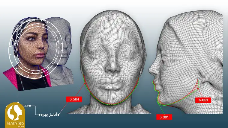 مرحله سوم تزریق ژل و بوتاکس به روش اسکن سه بعدی