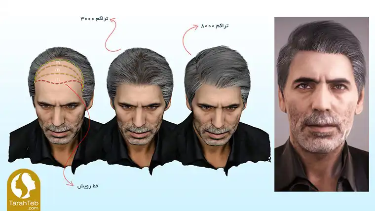 مرحله سوم کاشت مو