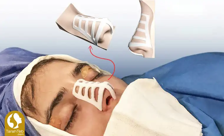 مرحله پنجم جراحی بینی با قالب کنترلی