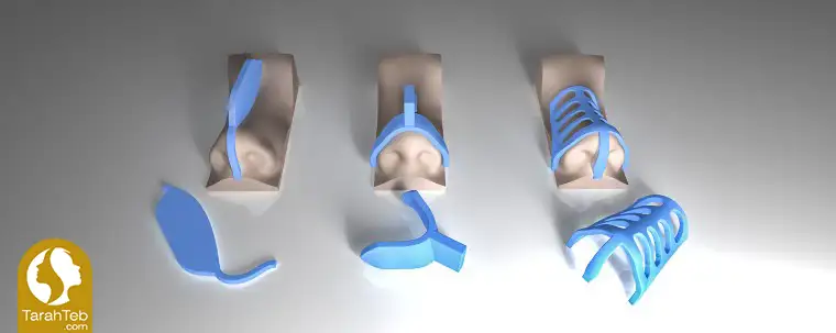 مرحله چهارم جراحی بینی با قالب کنترلی