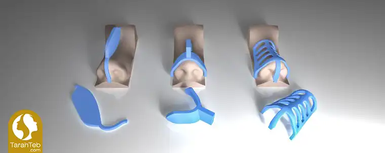 مرحله چهارم جراحی بینی با قالب کنترلی