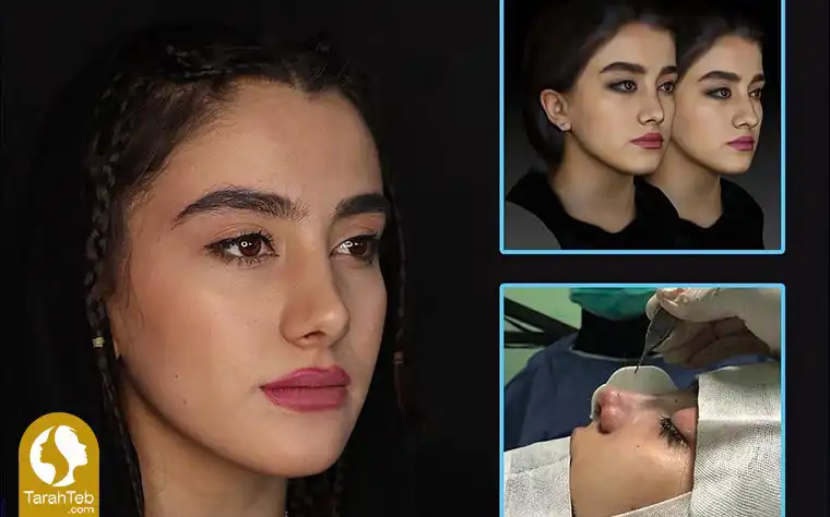 مشاوره قبل از جراحی بینی نیمه فانتزی