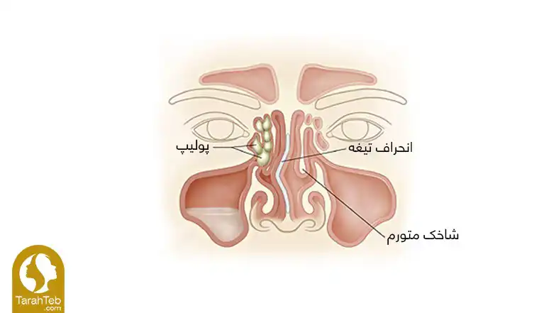 مشکلات تنفسی بینی