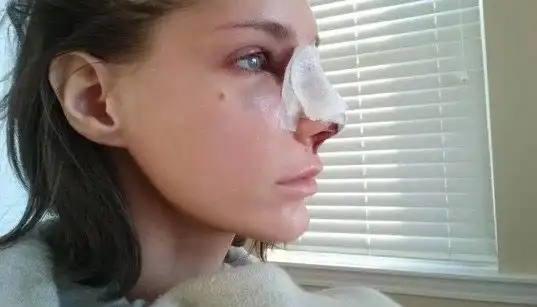 مقابله با تورم و کبودی بعد از عمل بینی