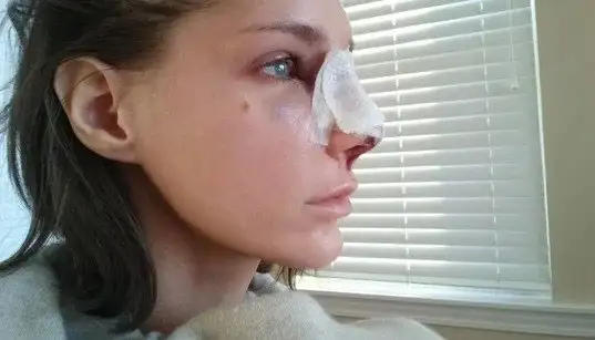 مقابله با تورم و کبودی بعد از عمل بینی