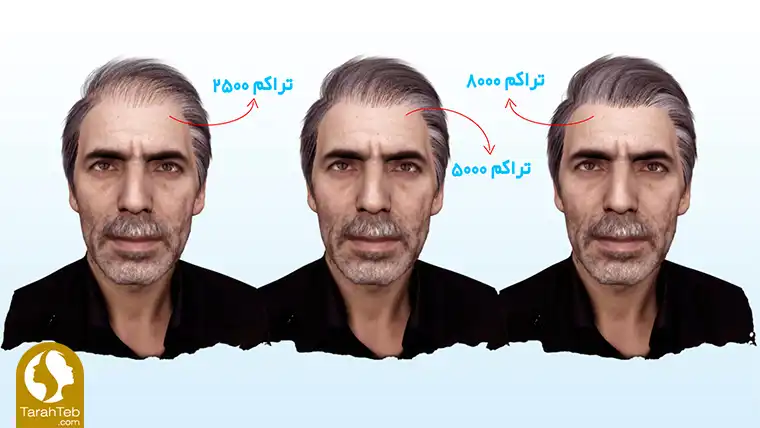 مقدار تراکم کاشت مو