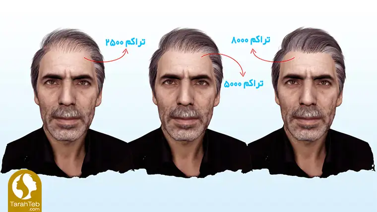 مقدار تراکم کاشت مو