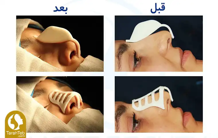منظور از عمل بینی با لیزر