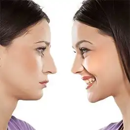 موفقیت عمل جراحی زیبایی بینی
