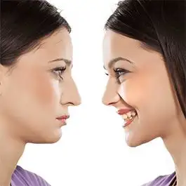 موفقیت عمل جراحی زیبایی بینی