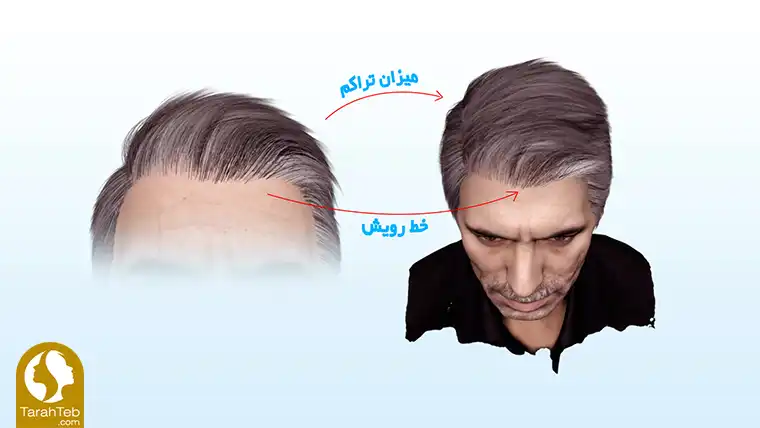 میزان تراکم و خط رویش مو