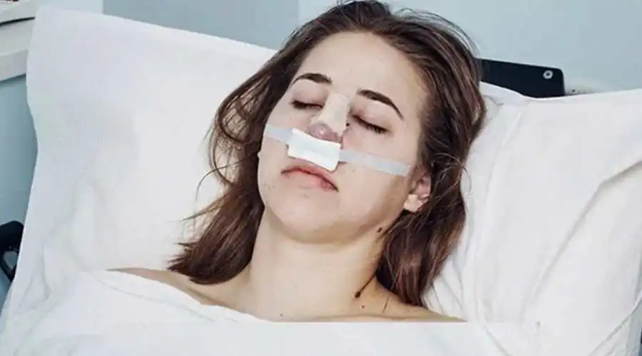 نحوه خوابیدن بعد از عمل بینی به چه صورت است؟