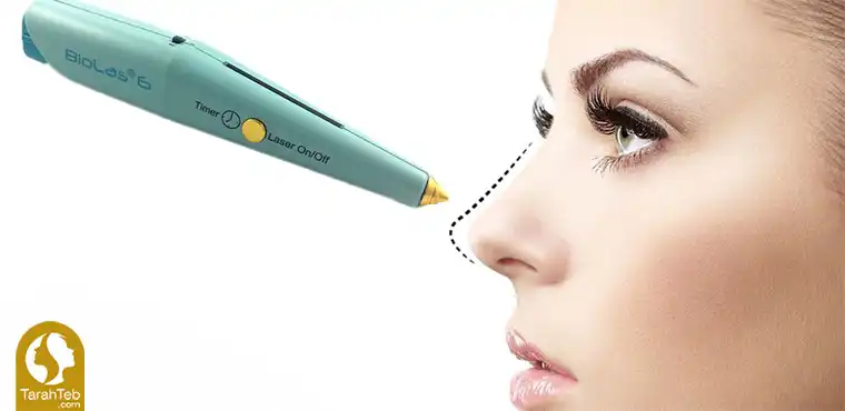 نحوه‌ی عمل بینی با لیزر