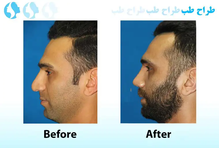 نمونه عمل بینی گوشتی