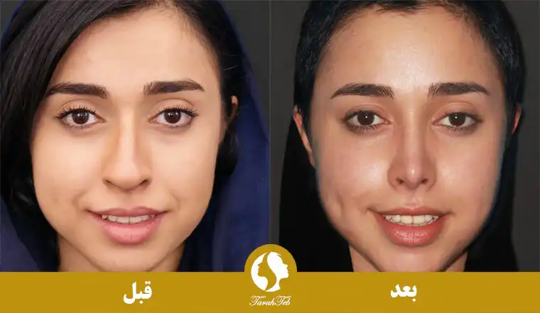 نمونه عکس جراحی بینی