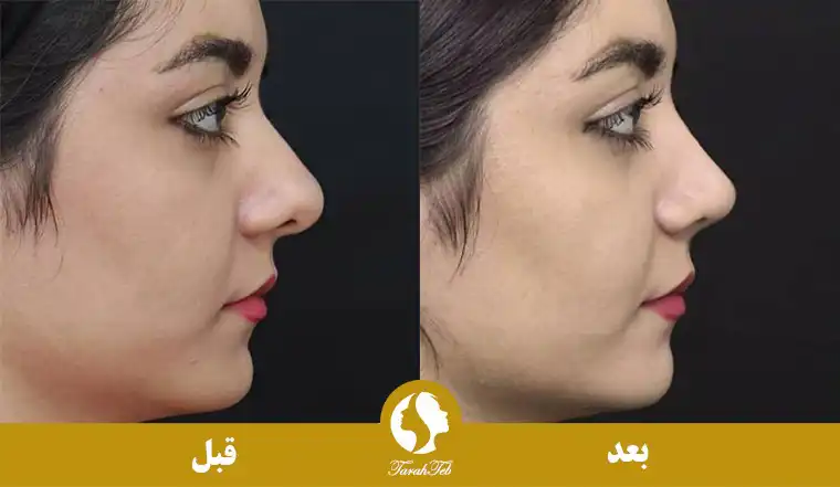 نمونه عکس جراحی بینی گوشتی