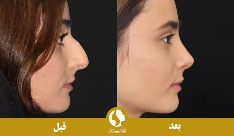 نمونه عکس عمل بینی