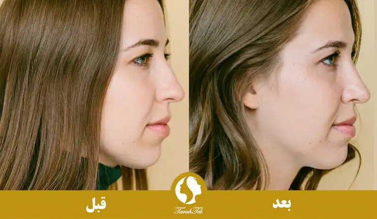 نمونه عکس عمل بینی