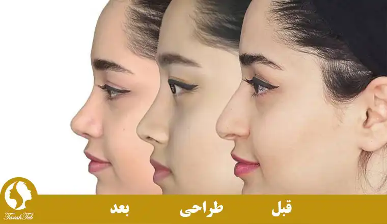 نمونه عکس عمل بینی طراح طب