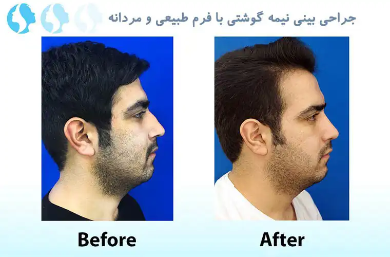 نمونه کار عمل بینی طبیعی