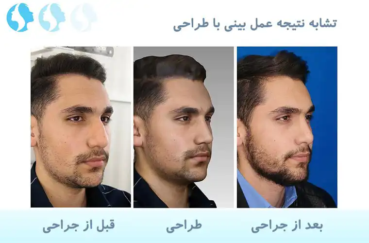 نمونه کار عمل بینی مردان
