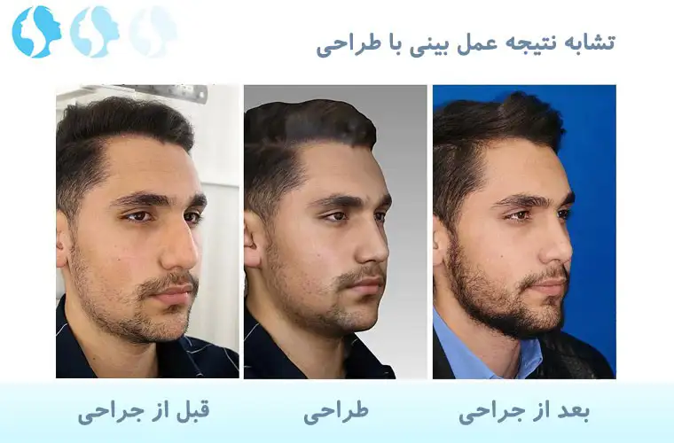 نمونه کار عمل بینی مردان