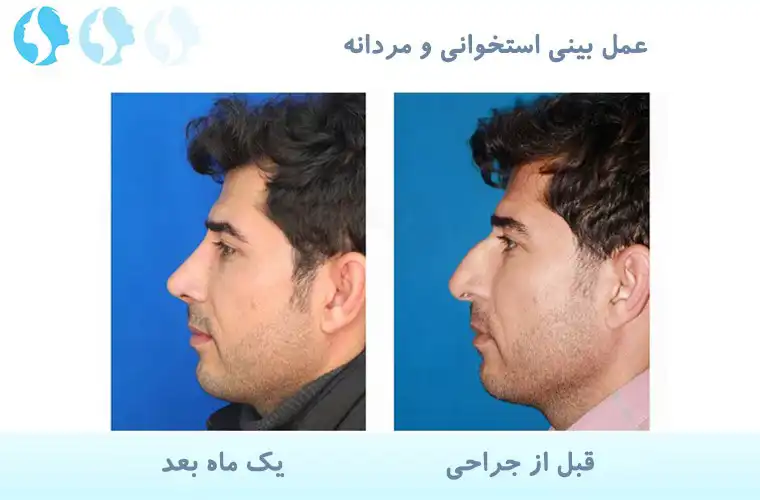 نمونه کار عمل بینی مردانه