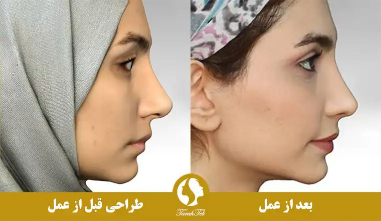 نمونه کار عکس عمل بینی