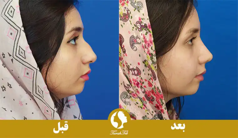نمونه کار موفق عمل بینی استخوانی