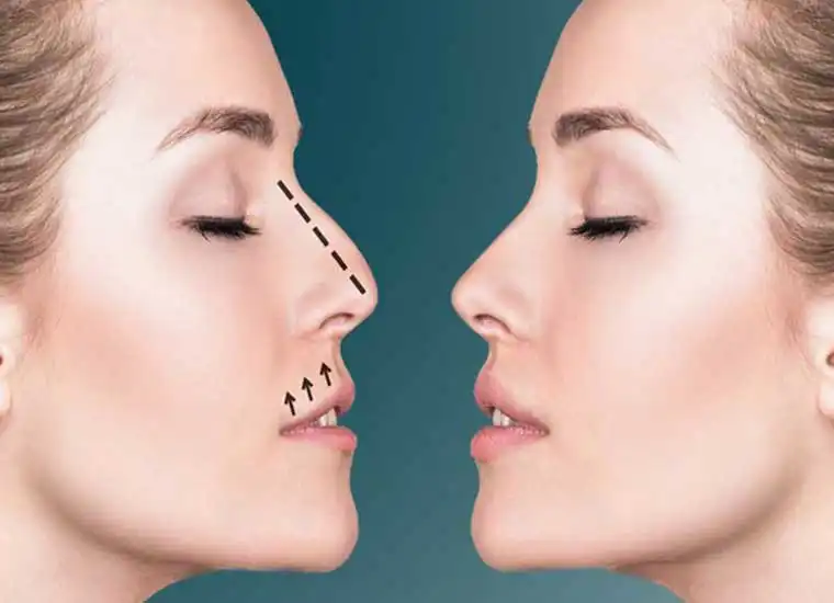 نکات کلیدی درباره ورزش بعد از عمل بینی