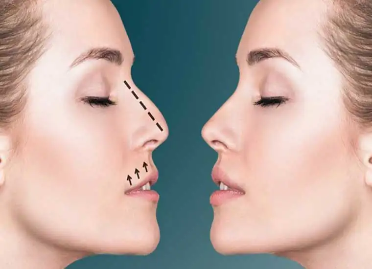 نکات کلیدی درباره ورزش بعد از عمل بینی