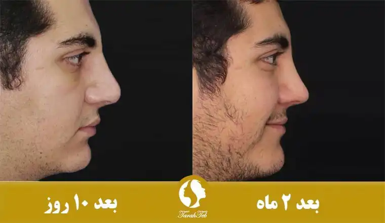 ورم استخوان بینی بعد از عمل