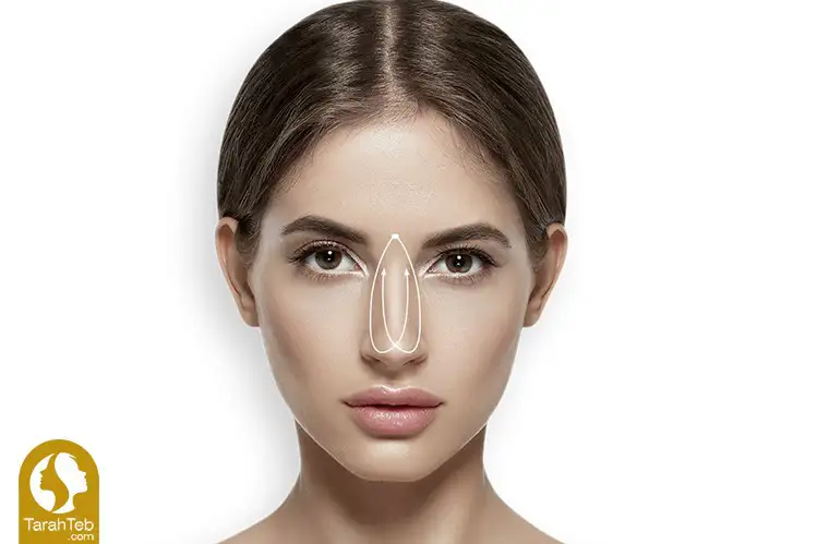 پیوند غضروف در عمل بینی