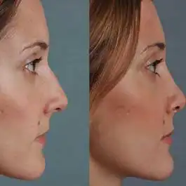 چگونه از تغییر نوک بینی بعد از عمل و افتادگی آن جلوگیری کنیم؟