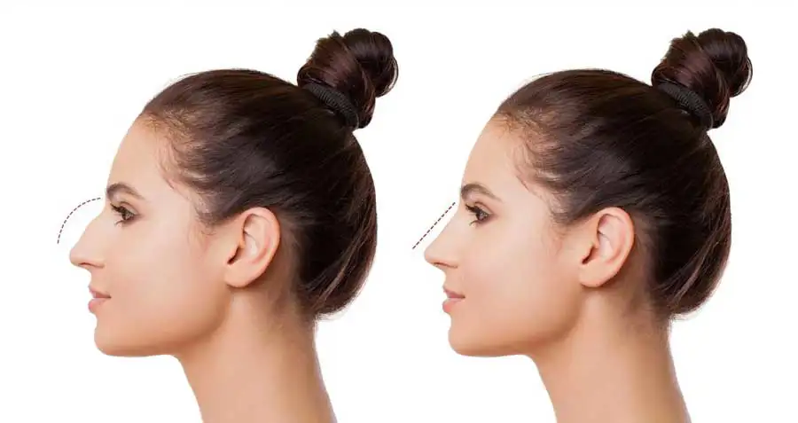 چگونه از تغییر نوک بینی بعد از عمل و افتادگی آن جلوگیری کنیم؟