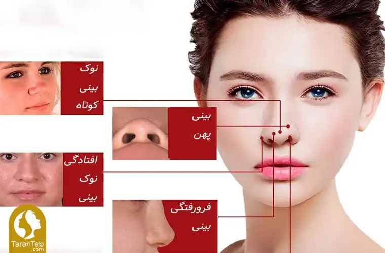 کاربردهای پیوند غضروف در عمل بینی