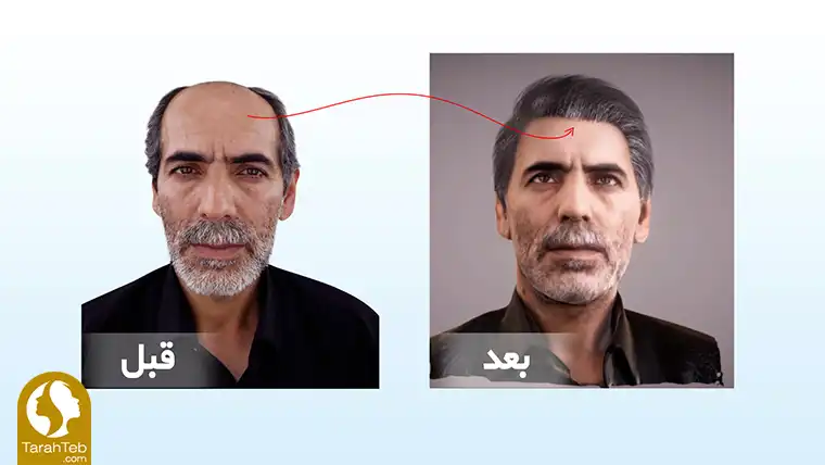 کاشت سه بعدی مو در اسکن سه بعدی