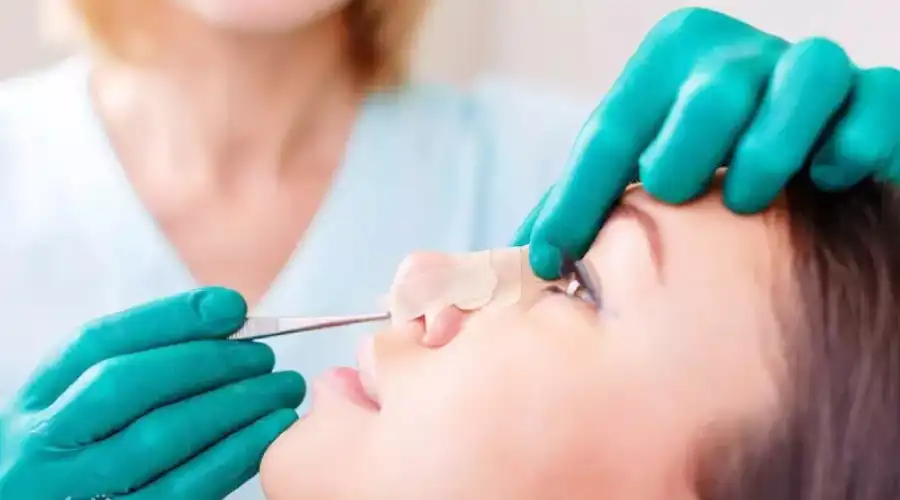 کلوئید یا گوشت اضافه بعد از عمل بینی