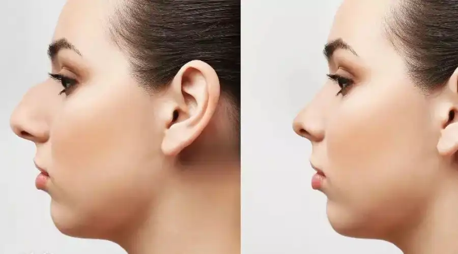 کلوئید یا گوشت اضافه بعد از عمل بینی