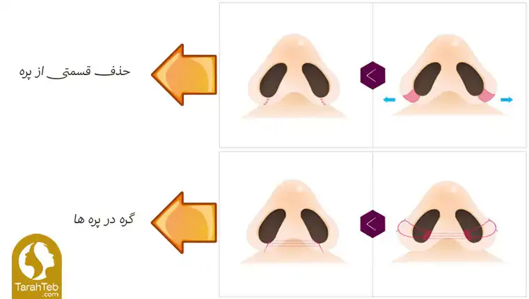 کوچک کردن پره های بینی