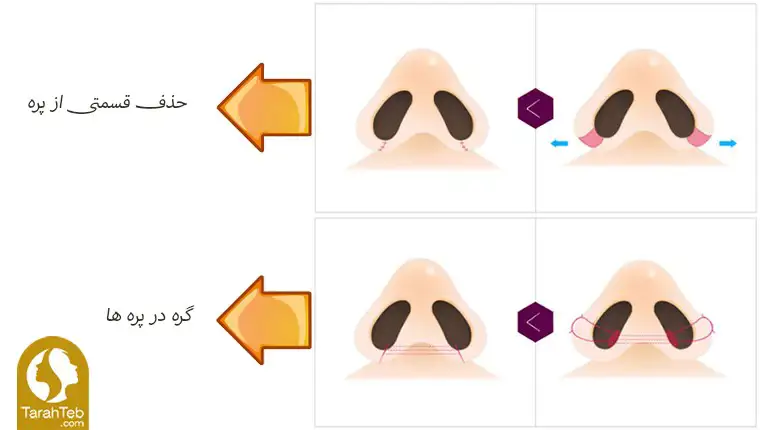 کوچک کردن پره های بینی