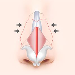 Wide nose rhinoplasty