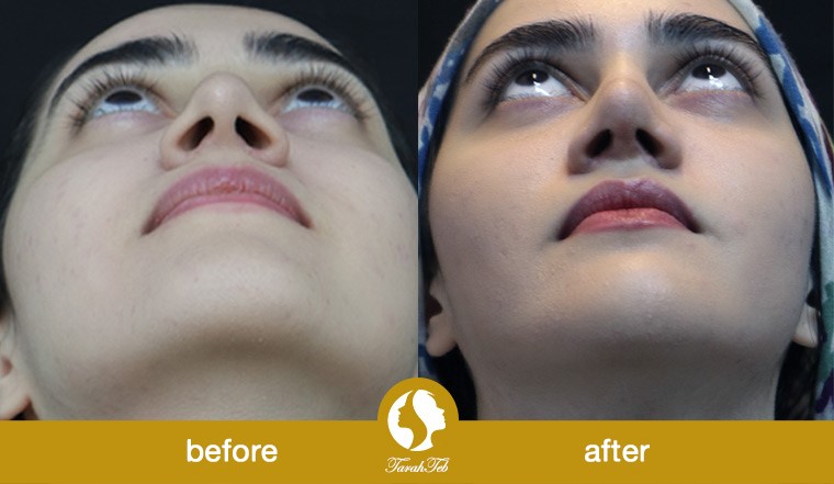 alar reduction surgery