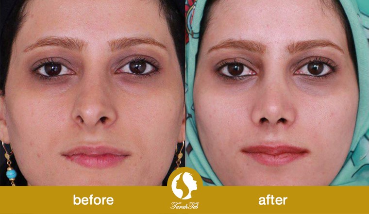 before after crooked nose