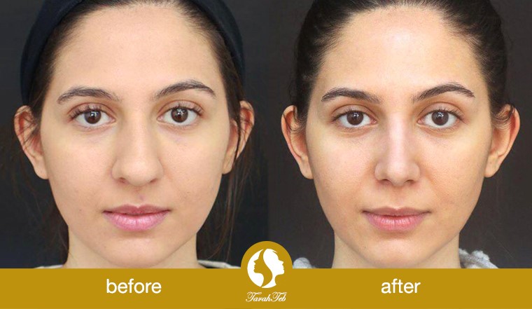 before after wide nose surgery