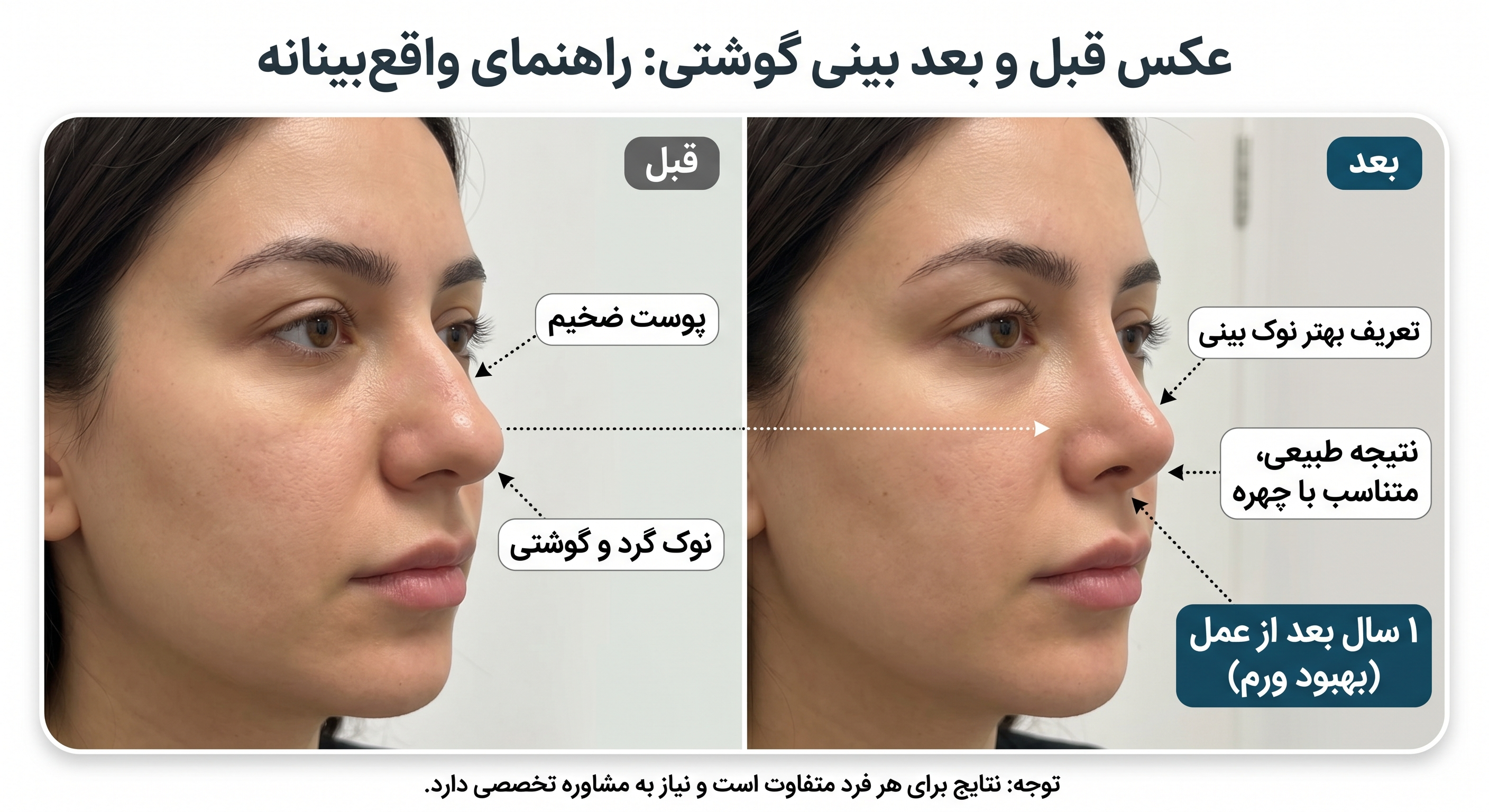 گالری عکس قبل و بعد عمل بینی گوشتی با فیلترهای مقایسه
