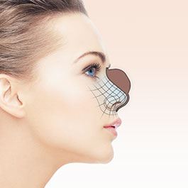 Rhinoplasty