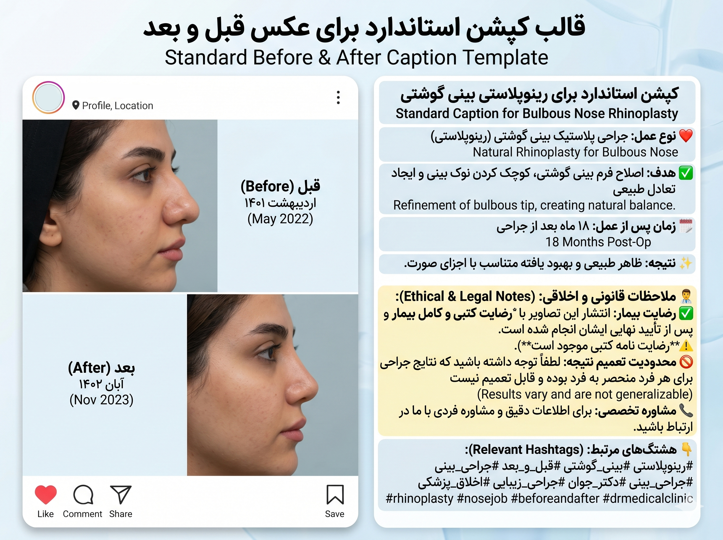 قالب کپشن عکس قبل و بعد عمل بینی گوشتی