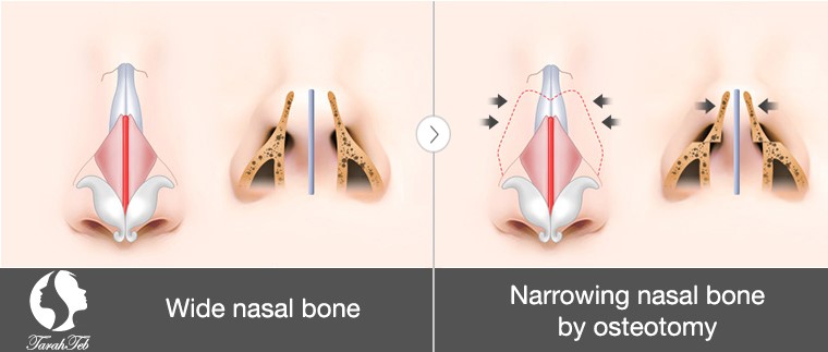 wide nose surgery